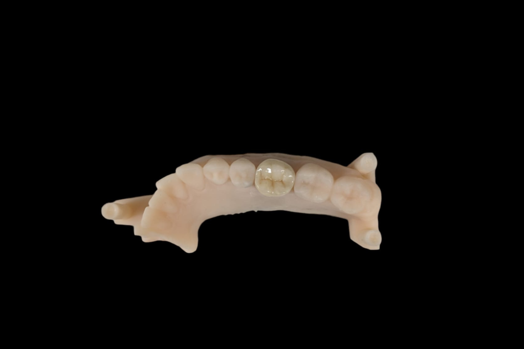 dentures 3 (3)